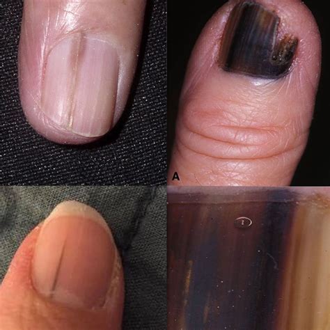 black lining on nails|black spot under toenail melanoma pictures.